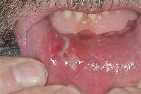 Mouth Ulcer Inside Lower Lip Stock Image C0473039 Science Photo
