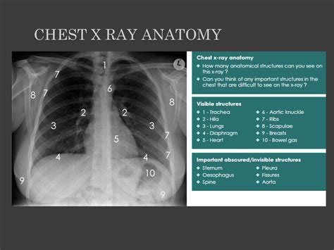 Normal X Ray Chest Findings Normal Chest X Ray Anatomy Tutorial