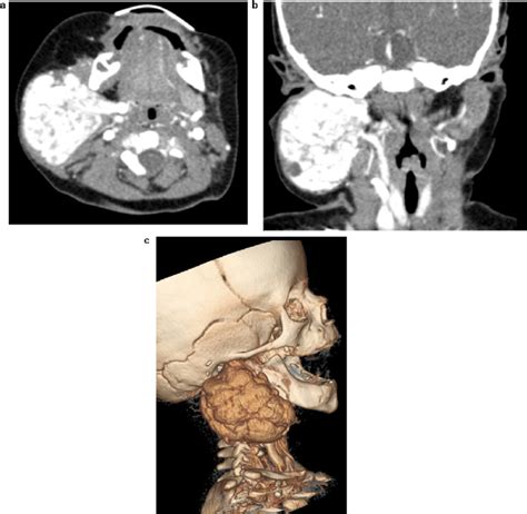 T2 Weighted Horizontal A And Coronal B Mri Scans Of The Tumour And