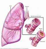 Treatment For Asthmatic Bronchitis Mayo Clinic Images