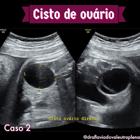 Cisto de ovário fetal