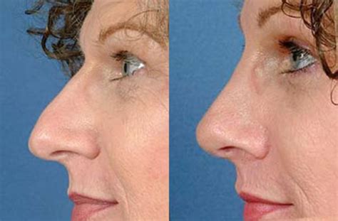 Nose Reshaping Before And After Photos Patient 99 Louisville Ky