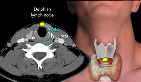 Delphian Lymph Node