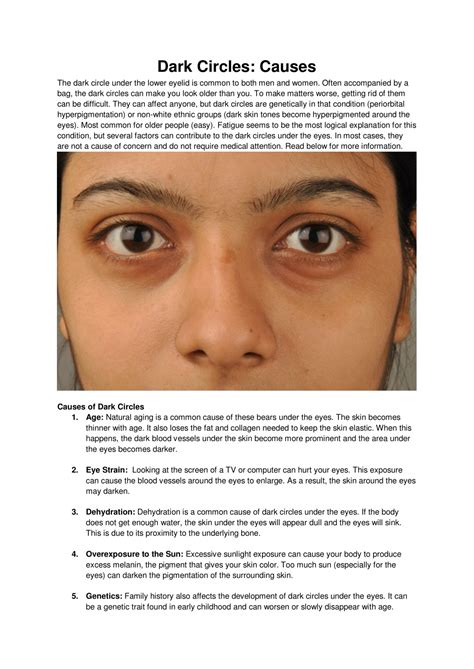 Ppt Dark Circles Causes Powerpoint Presentation Free Download Id