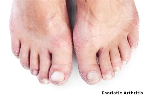 Psoriatic Arthritis Foot Specialist Toronto Feet First Clinic