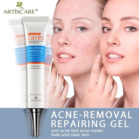 Beauty Treatments For Acne Scars Rijals Blog