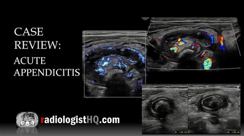 Ultrasound Of Acute Appendicitis Youtube