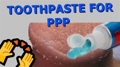 Pearly Penile Papules Removal The Wonders Of Toothpaste Youtube