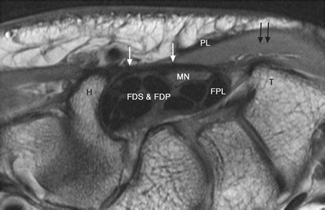 Normal Intermediate Weighted Axial Mri Of The Outlet Of The Carpal