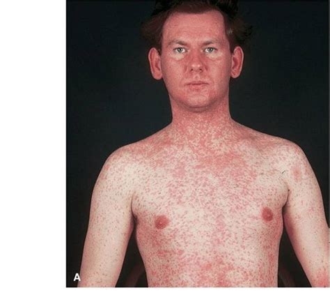 Viral Diseases Of Skin And Mucosa Fitzpatricks Color Atlas And