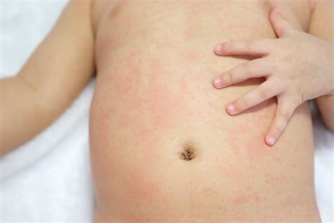 Skin Rashes On Toddlers