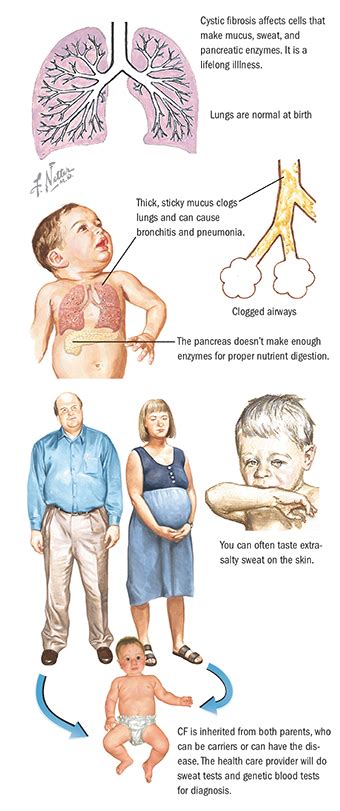 Types Of Cystic Fibrosis