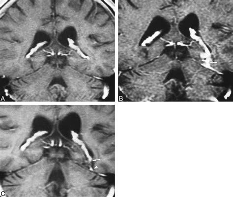 Choroid Plexus Changes After Temporal Lobectomy American Journal Of