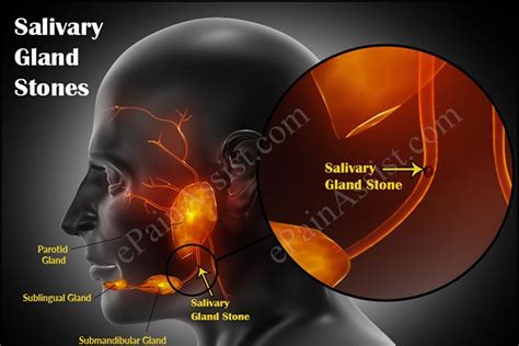 The Healthy Tips Causes Of Salivary Gland Stones And Its Treatment Home