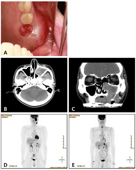 Recurrent Maxillary Sinus Cancer With Only Adrenal Metastasis