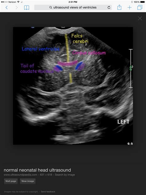 Fetal Brain Anatomy Ultrasound