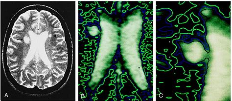 Characterization Of White Matter Lesions In Multiple Sclerosis And