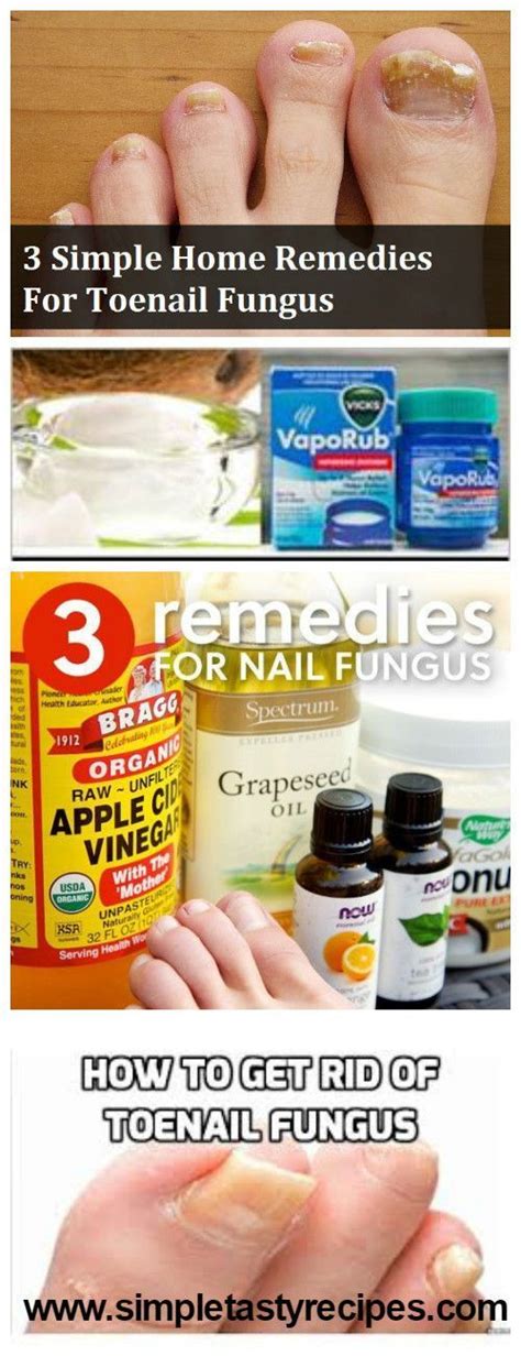 3 Simple Home Remedies For Toenail Fungus Toe Nails