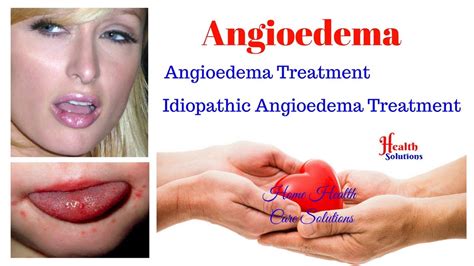 Angioedema Angioedema Treatment Idiopathic Angioedema Treatment Youtube
