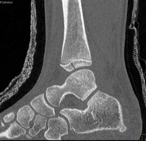 Tibial Fractures Through The Epiphysis And Widening Of The Epiphyseal