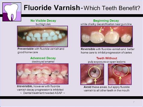 How To Apply Fluoride Varnish On Teeth Teeth Poster