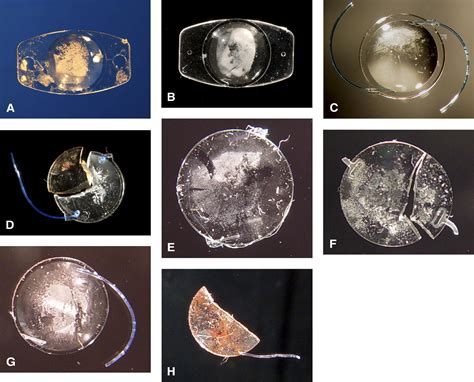 Calcification Of Different Designs Of Silicone Intraocular Lenses In