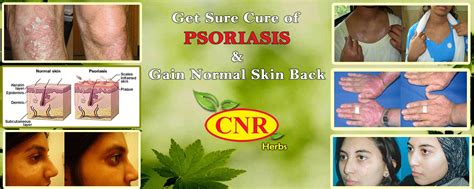 Ayurvedic Treatment For Psoriasis — Cnr Herbs By Cnrherbs Medium