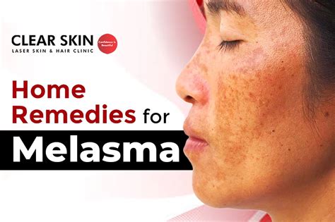 Home Remedies For Melasma Natural Solutions