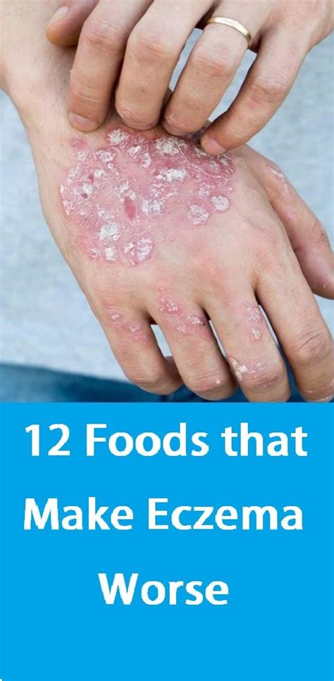 12 Foods That Make Eczema Worse Page 7 Eczema Home Remedies For