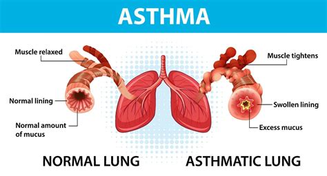 Bronchial Asthma Diagram With Normal Lung And Asthmatic Lung 3567446