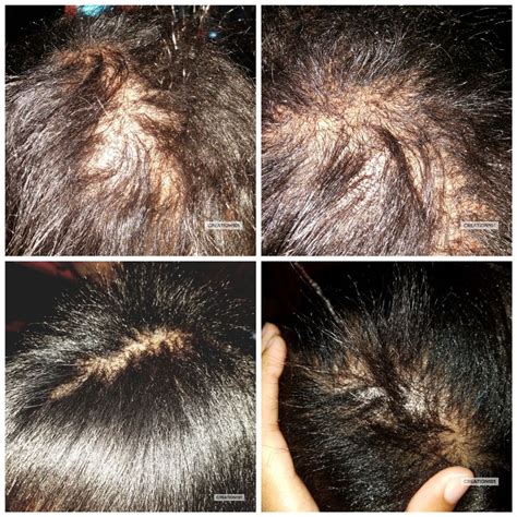 It is a common problem for many people especially americans. GG Hair & Scalp Quickener | Growing healthy hair, Hair ...