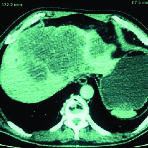 Abdominal Ct Scan Shows Multiple Liver Metastases Download