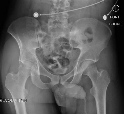 Bilateral Hip Dislocation Post Reduction Xray Jetem 2017 Jetem