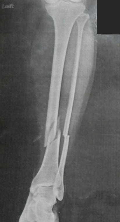 tibial shaft fracture hot sex picture