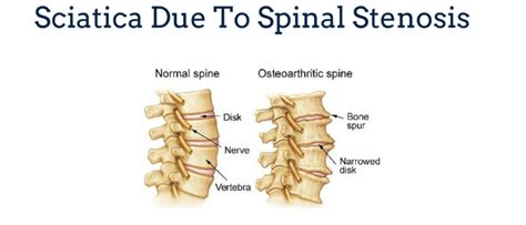 Sciatica Due To Spinal Stenosis Gray Chiropractic Stcatharines Spine