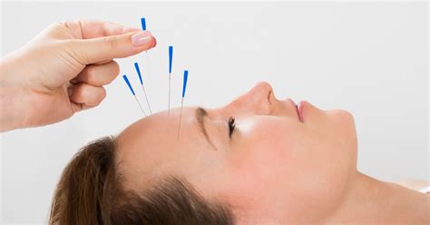 Acupuncture Treatment For Migraine Acupuncture Halls