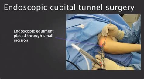 Endoscopic Equipment Placed Through Small Incision Cubital Tunnel