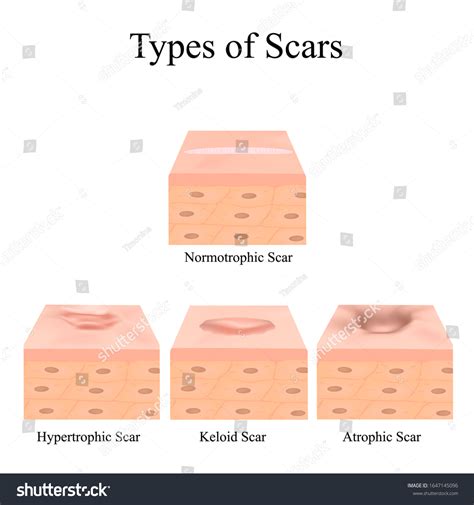Types Scars Acne Scars Keloid Hypertrophic Ilustrações Stock