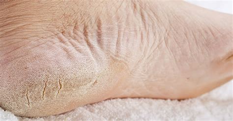 Skin Care Tips How To Treat Cracked Feet