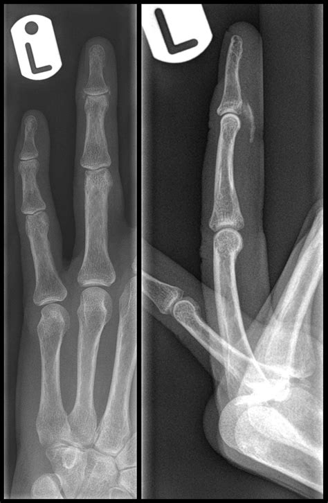 An Endoscopist With A Painful Finger The Bmj