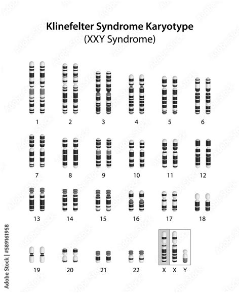 Klinefelter Syndrome Xxy Syndrome Karyotype Stock Illustration Adobe Stock