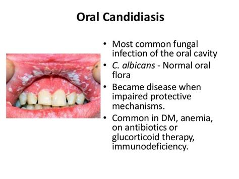 Oral Cavity And Salivary Gland Diseases