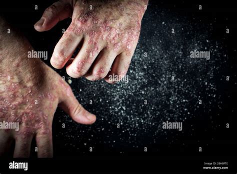 Psoriasis Eczema On The Hand Man Itching Skin Psoriasis Scales Are