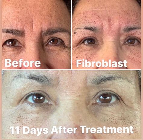 Fibroblast Plasma Skin Tightening Treatment North Carolina — Izar