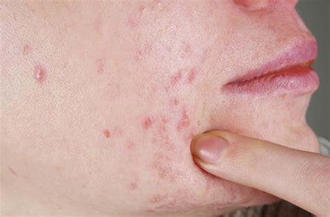 Indented Scarring How To Get Rid Of Pitted Acne Scars Lifestyle