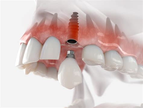 Implants Vs Dentures Which Is Right For You