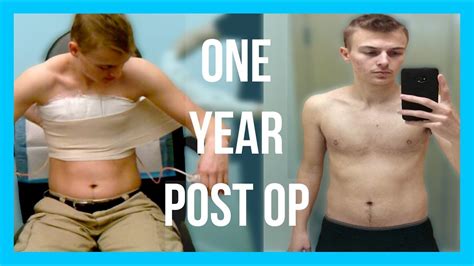 Trans 1 Year Post Top Surgery Comparison Video Dr Garramone Youtube