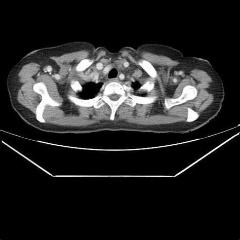 Aortic Dissection Radiopaedia 25350 25604 C Nc Commons