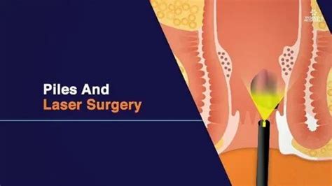 Pile Surgery Pile Surgery Service In India