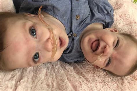 Conjoined Identical Twins Born Wrapped In An Embrace Are Successfully